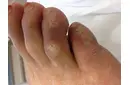 Ayak Parmağında Nasır Belirtileri ve Tedavisi